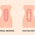 split abs after birth