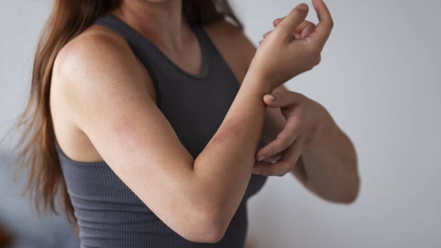 Winter rash or eczema? A dermatologist explains the difference and when to seek help