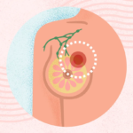 What Is Breast Cancer? Symptoms, Causes, Diagnosis, Treatment, and Prevention