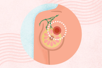 What Is Breast Cancer? Symptoms, Causes, Diagnosis, Treatment, and Prevention