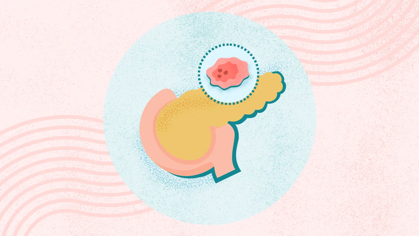 What Is Pancreatic Cancer?