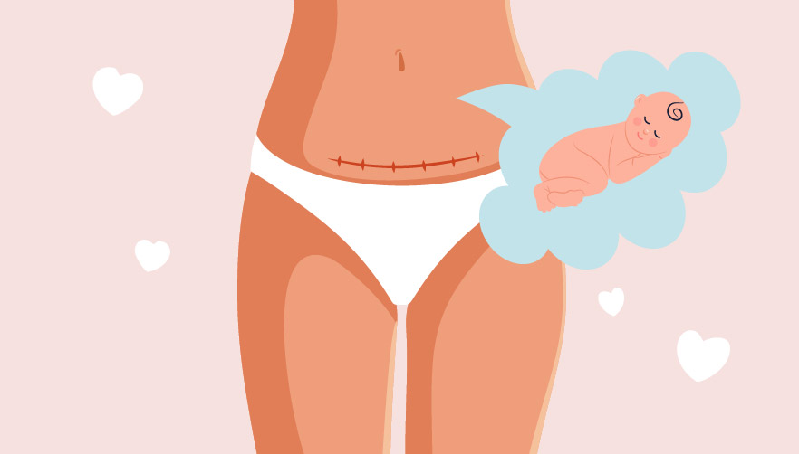 does a c section affect the baby