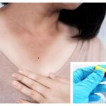 Dark patches on your child’s neck? Doctor says it may be a sign of insulin resistance