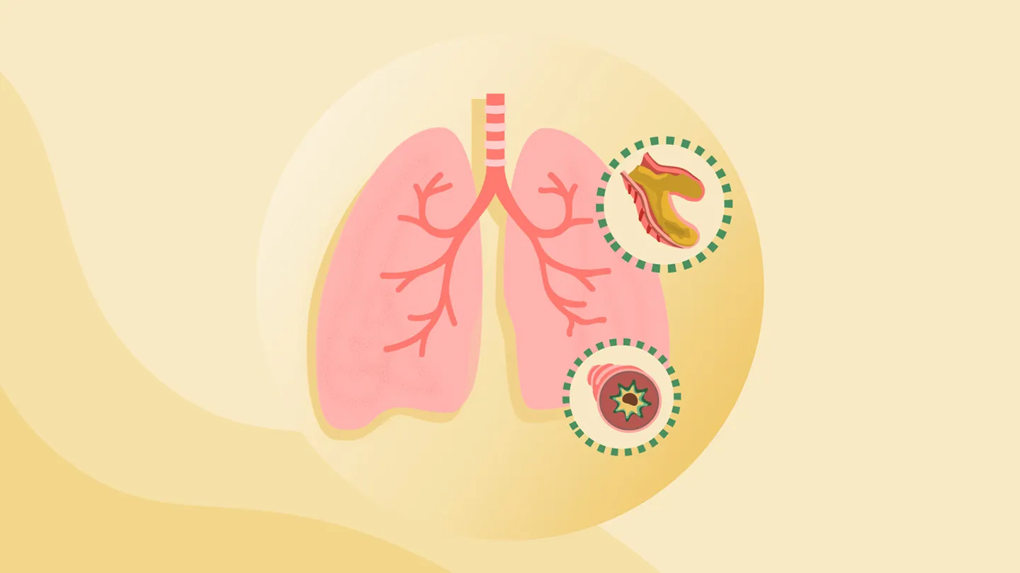 What Is Bronchiectasis?
